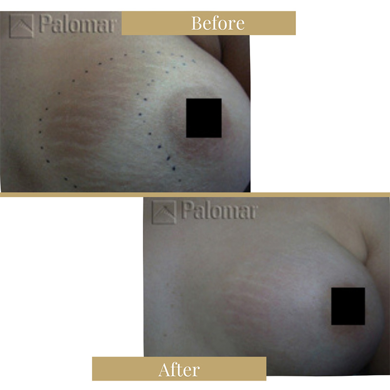 Stretch Mark and Scar Reduction